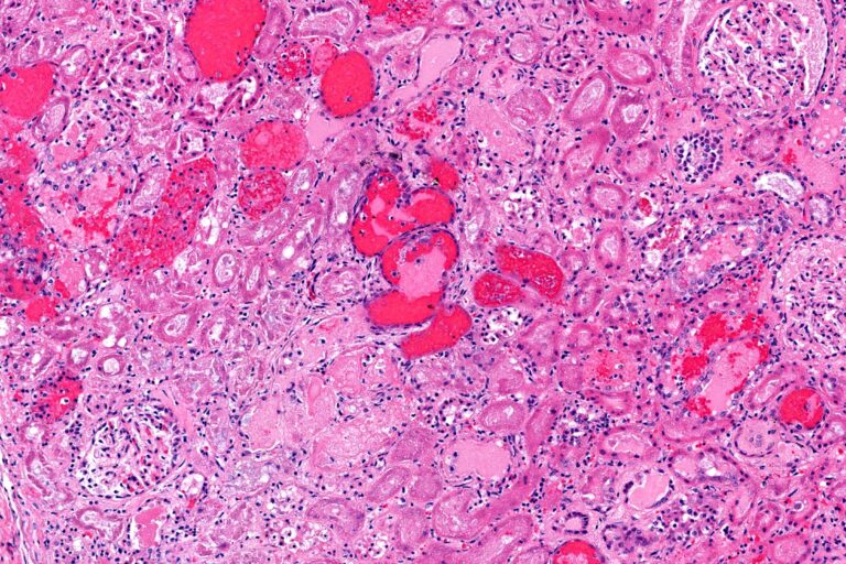 Síndrome Urémico Hemolítico: las claves para prevenir la enfermedad que no tiene cura