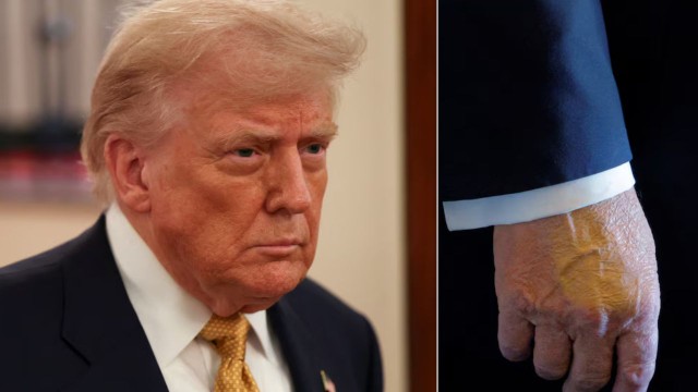 La Casa Blanca reveló que Trump sufre una “insuficiencia venosa crónica”: qué síntomas padece